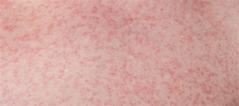 rash in dengue fever