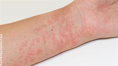 rash larder beetle bite