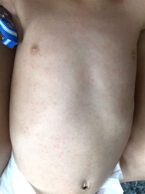 rash on baby body after fever