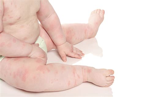 rash on child keeps coming back