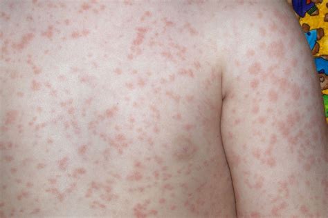 rash on children's chest and back