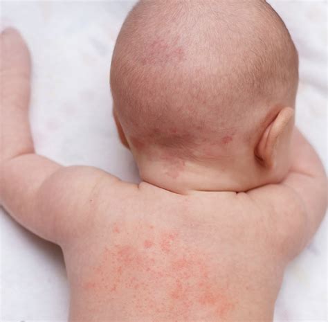 rash with no fever in baby