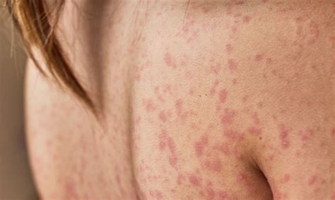 Amoxicillin Rash Pictures, Causes, Treatment and Risks
