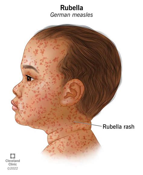 rashes of german measles