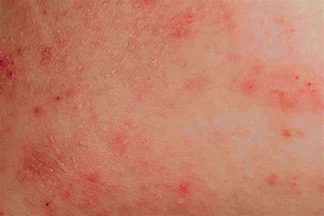 Soothing Relief: Understanding Rashes That Itch and Their Solutions