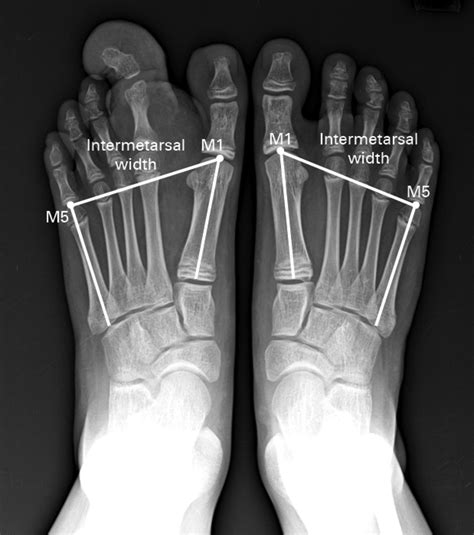 Demystifying Ray Amputation: Essential Facts