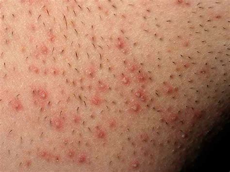 Razor Bump Red Bumps