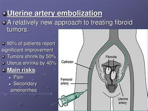 rcog uterine artery embolisation leaflet
