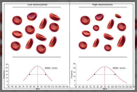 Understanding RDW Lab Test Low: What Does It Mean for Your Health?