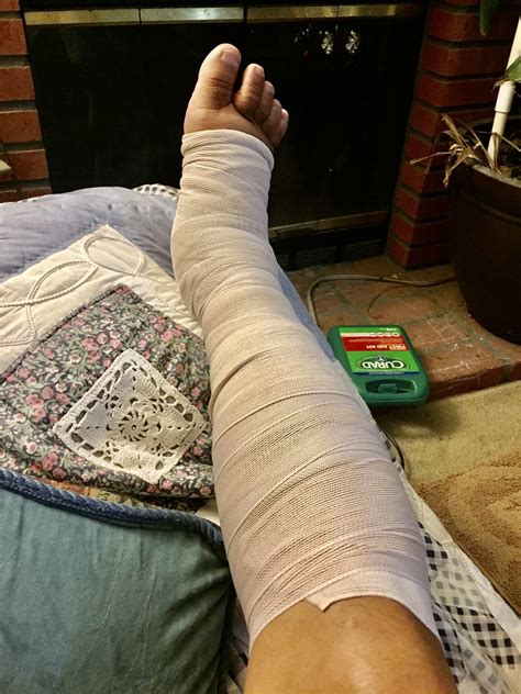 Injury Leg. Bandaged Leg of Unidentified Person Stock Photo Image of