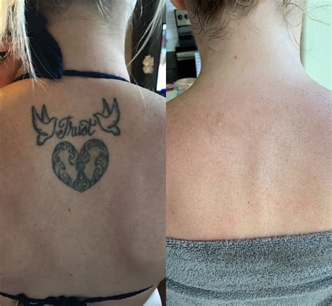 real self tattoo removal