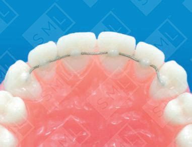 Rebonding Lingual Retainer