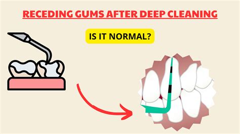 Receding Gums Teeth Cleaning