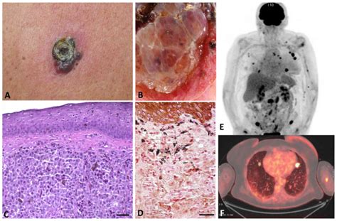 recidiva melanoma maligno pt1a