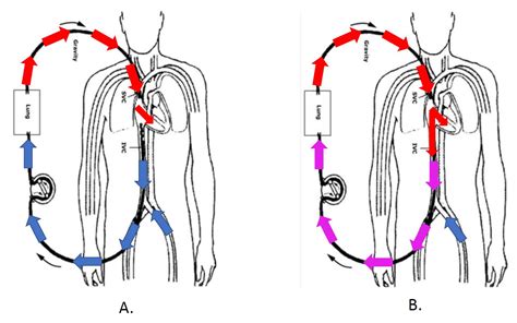 Recirculation In Ecmo