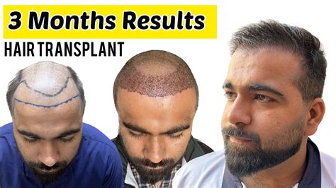 recover hair transplant centre