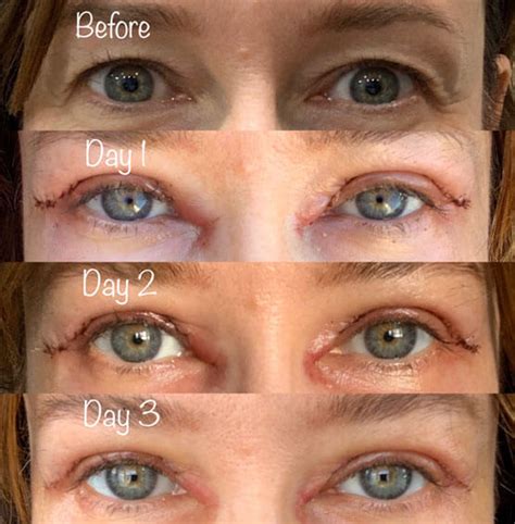 9 Tips to Speed Recovery After Eyelid Surgery (Blepharoplasty)
