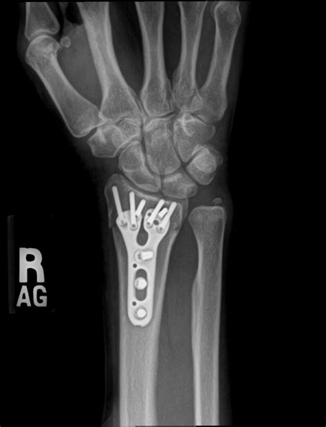 recovery after orif wrist fracture