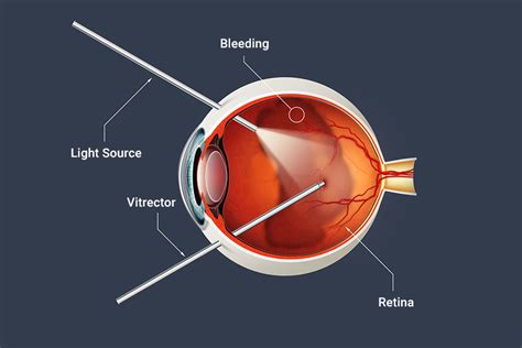 recovery from vitrectomy eye surgery