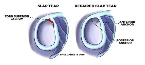 recovery time for slap tear surgery