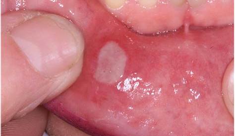 Recurrent aphthous stomatitis, with major aphthae on soft palate