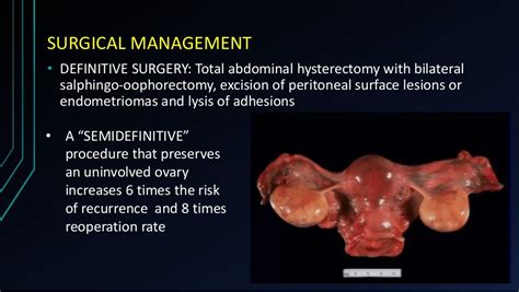 recurrent endometriosis after oophorectomy