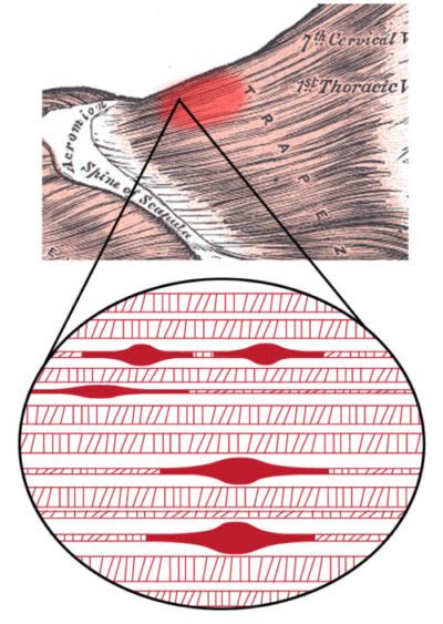 recurring trigger points
