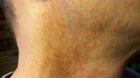 red blotchy skin on back of neck