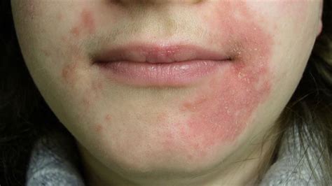 Red Bumps Around Mouth: Causes, Symptoms, and Effective Treatments