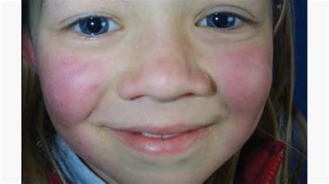 Red Cheeks After Taking Azithromycin