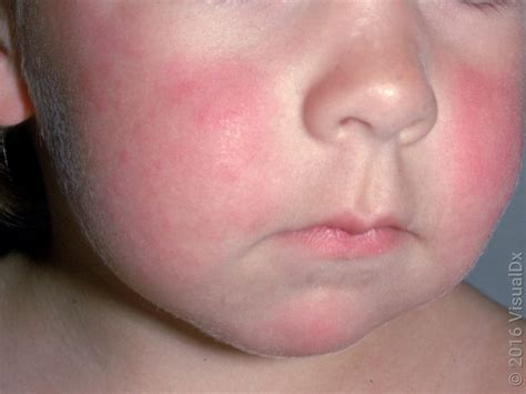 Red Cheeks Underlying Medical Condition