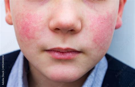 Red Cheeks Viral Infection