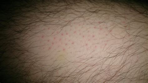 Red Dots From Epilator