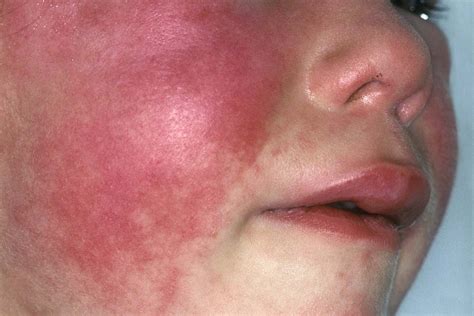 red eyes in scarlet fever