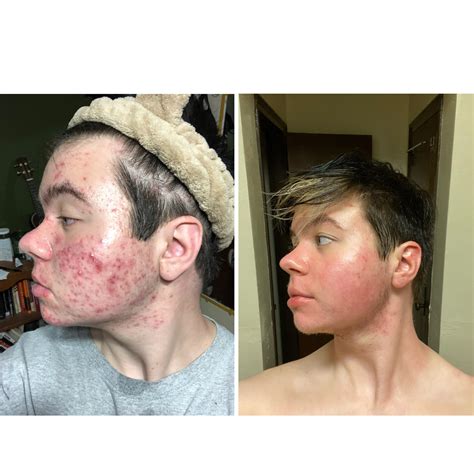 Red Face On Accutane