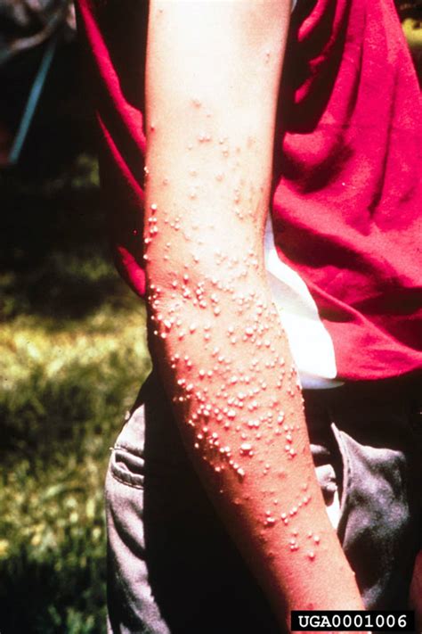 red imported fire ant bites