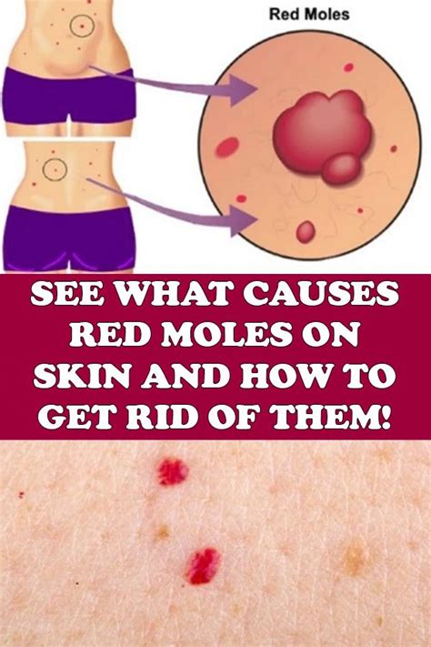 red moles appearing on skin