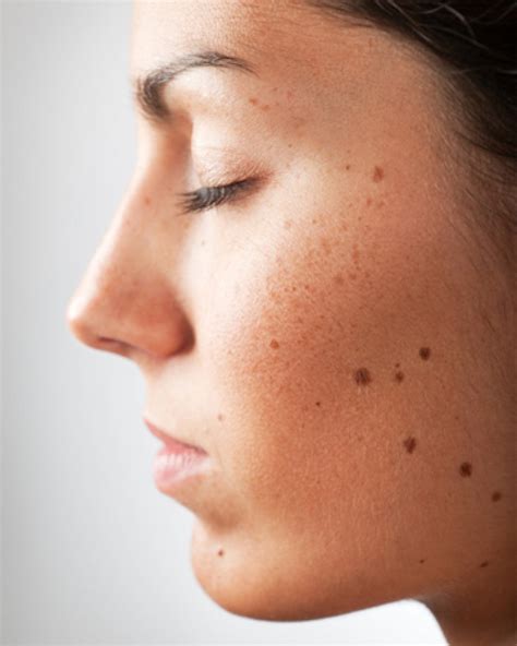 red moles on face