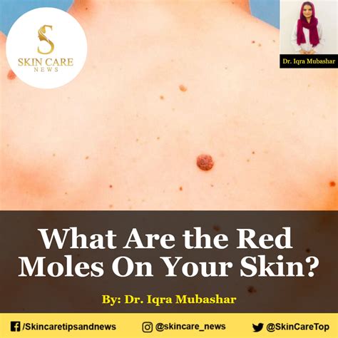 red moles on skin meaning