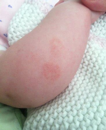 Red Patch On Toddler Arm