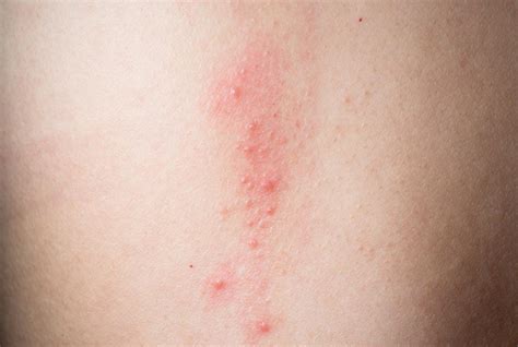 red rash on belly and chest