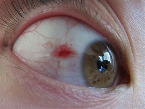 What Causes a Red Spot in Eye: Symptoms, Treatment, and When to Seek Help