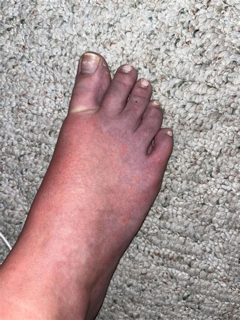 Red Swollen Extremities