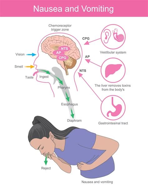 Reducing Nausea and Vomiting