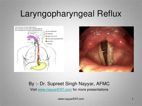 Reflux And Dummy Use