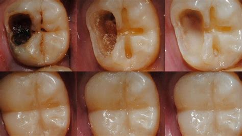 regrowing tooth enamel
