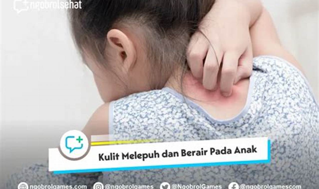 rekomendasi obat kulit melepuh pada anak