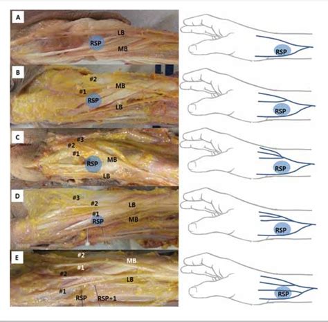 Release Of First Dorsal Compartment Cpt Code
