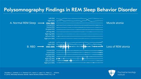 Rem Sleep Behavior Disorder Study Group