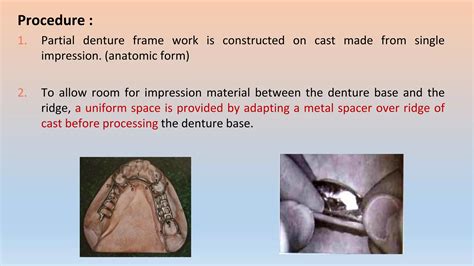 Removable Partial Denture Impression Technique